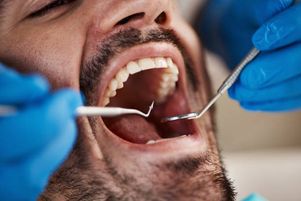Best Emergency Dental Extractions in New Rockford, ND